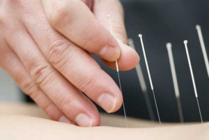 acupuncture-hand-needles
