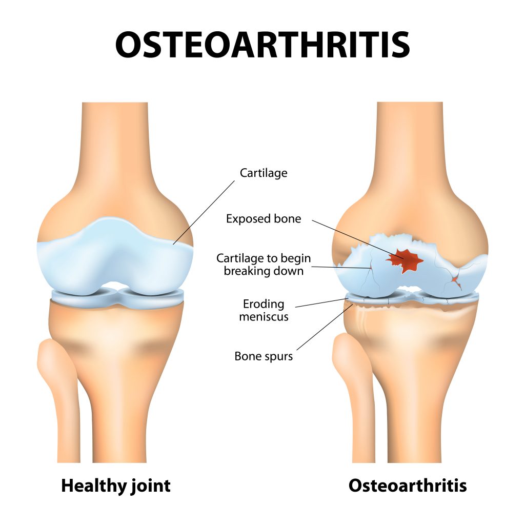 a térd korai osteoarthritis)